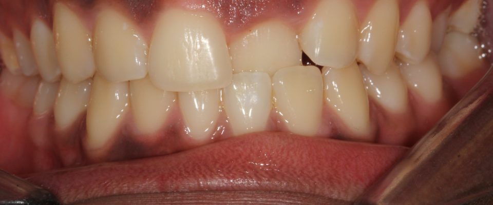 Tomas — teeth before treatment