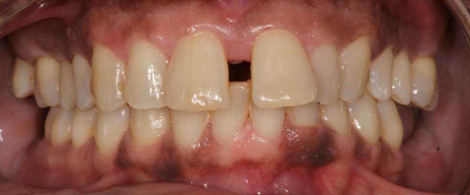 Sylvia — teeth before treatment