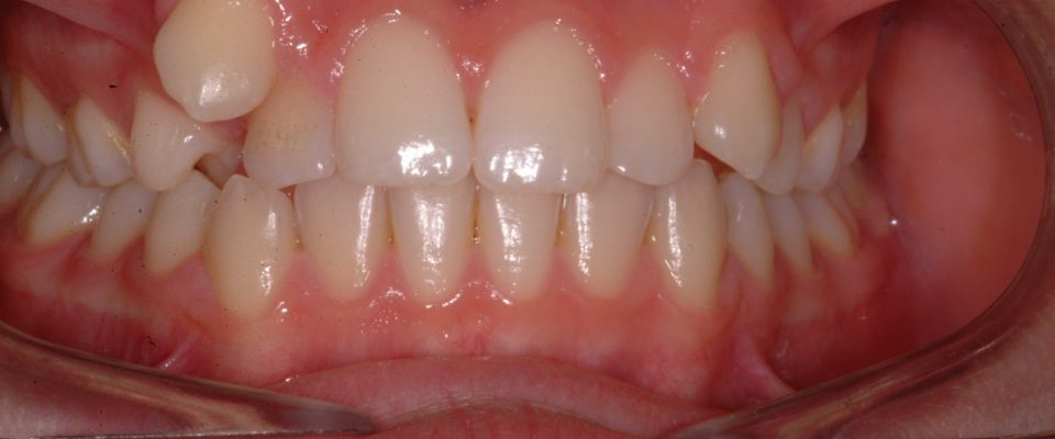 Sophia — teeth before treatment