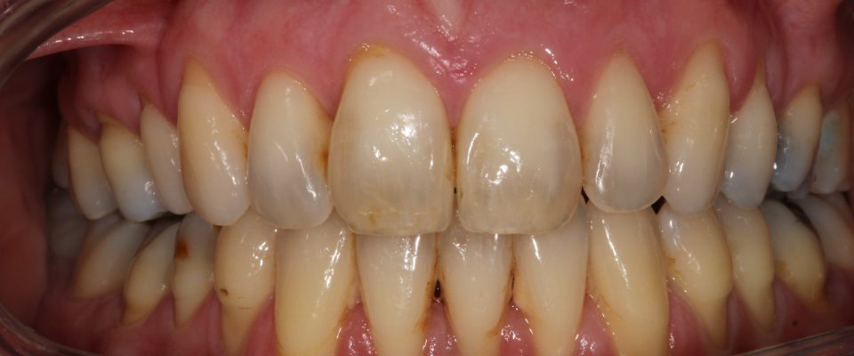 Sally — teeth after treatment
