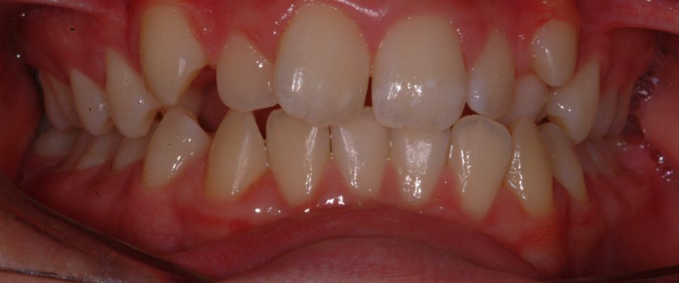 Ben — teeth before treatment