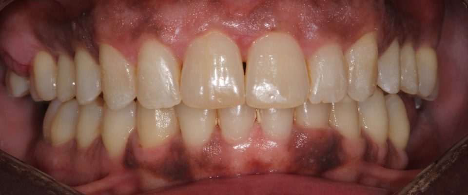Sylvia — teeth after treatment