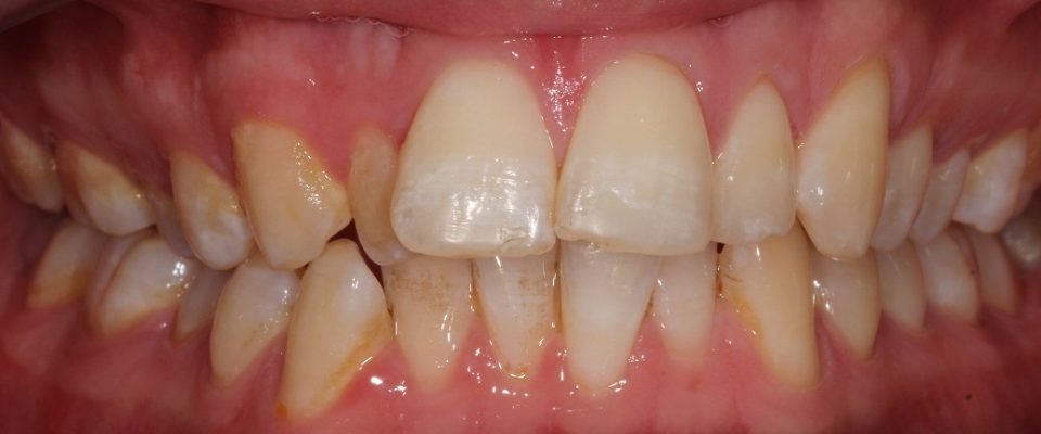 Crue — teeth before treatment