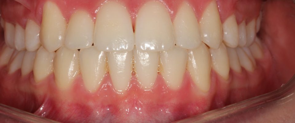 Sophia — teeth after treatment