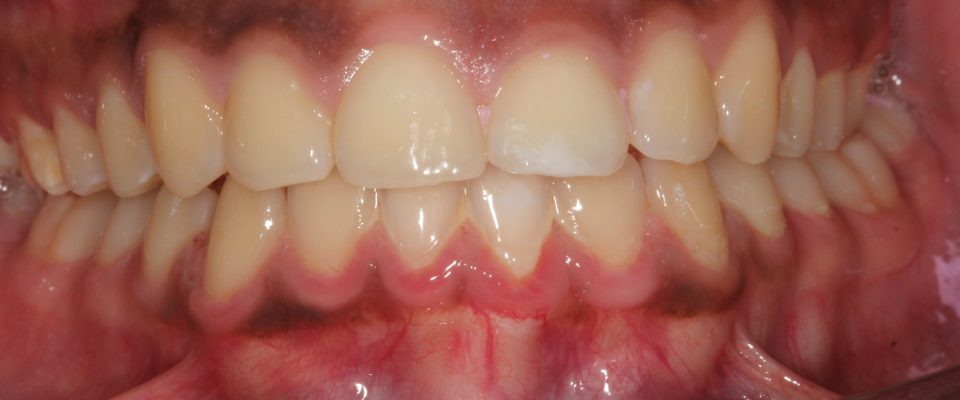 Tomas — teeth after treatment