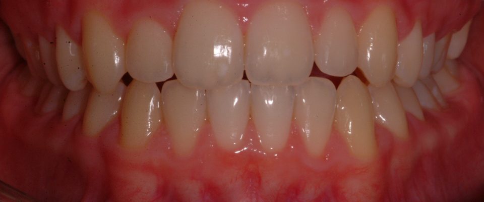Ben — teeth after treatment