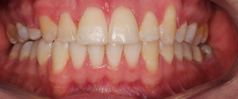 Crue — teeth after treatment