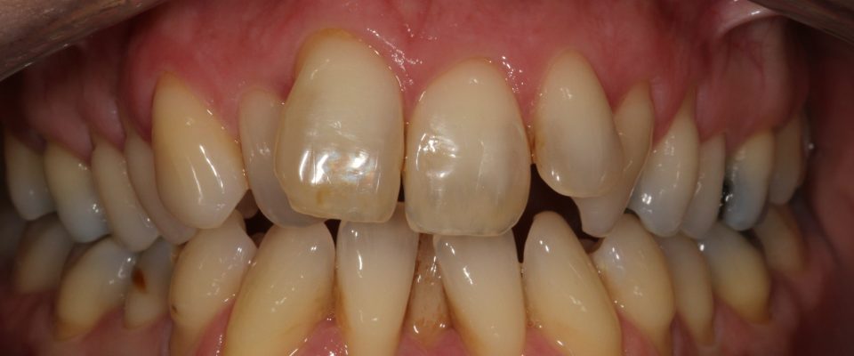 Sally — teeth before treatment